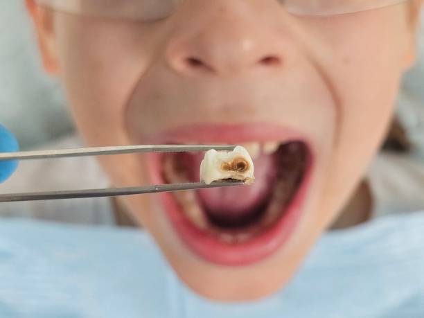 Best Emergency Treatment for Toothache in Flora, IN